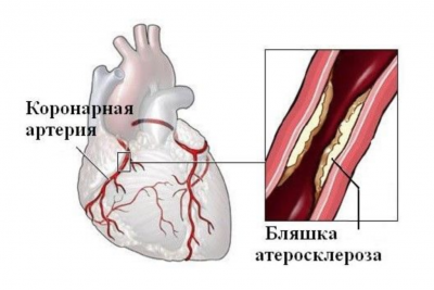 Атеросклероз